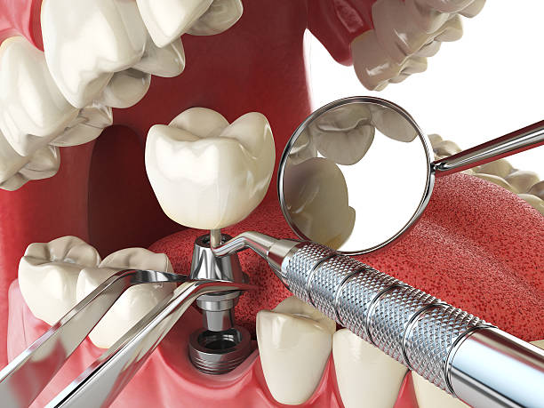 Best Emergency Root Canal Therapy in Gretna, LA